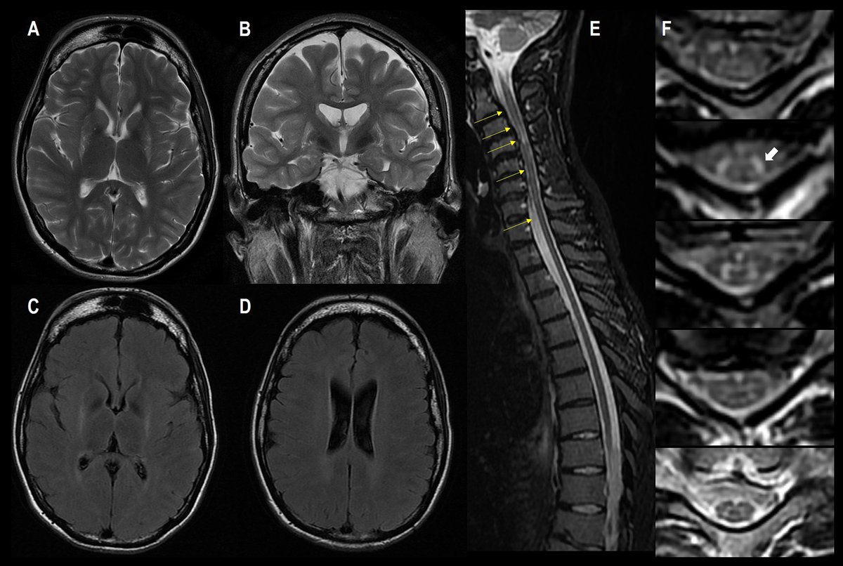 Clues for EIF2AK2-related dystonia <a href="/MDCP_Journal/">Movement Disorders Clinical Practice</a> <a href="/shekeeb/">Dr Shekeeb Mohammad</a> <a href="/_PankajAg/">Pankaj Agarwal</a> 
‐ Stress-related decompensation
- Posterior putaminal hyperintensity (dd: HIE sequelae, Type3 GM1)
- Periventricular white matter changes
- Hyperintensity along the corticospinal tract 
…mentdisorders.onlinelibrary.wiley.com/doi/10.1002/md…