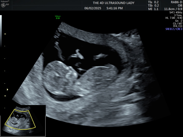 The4DLady's tweet photo. 13 week old babe #preborn https://t.co/TD255fsAs2