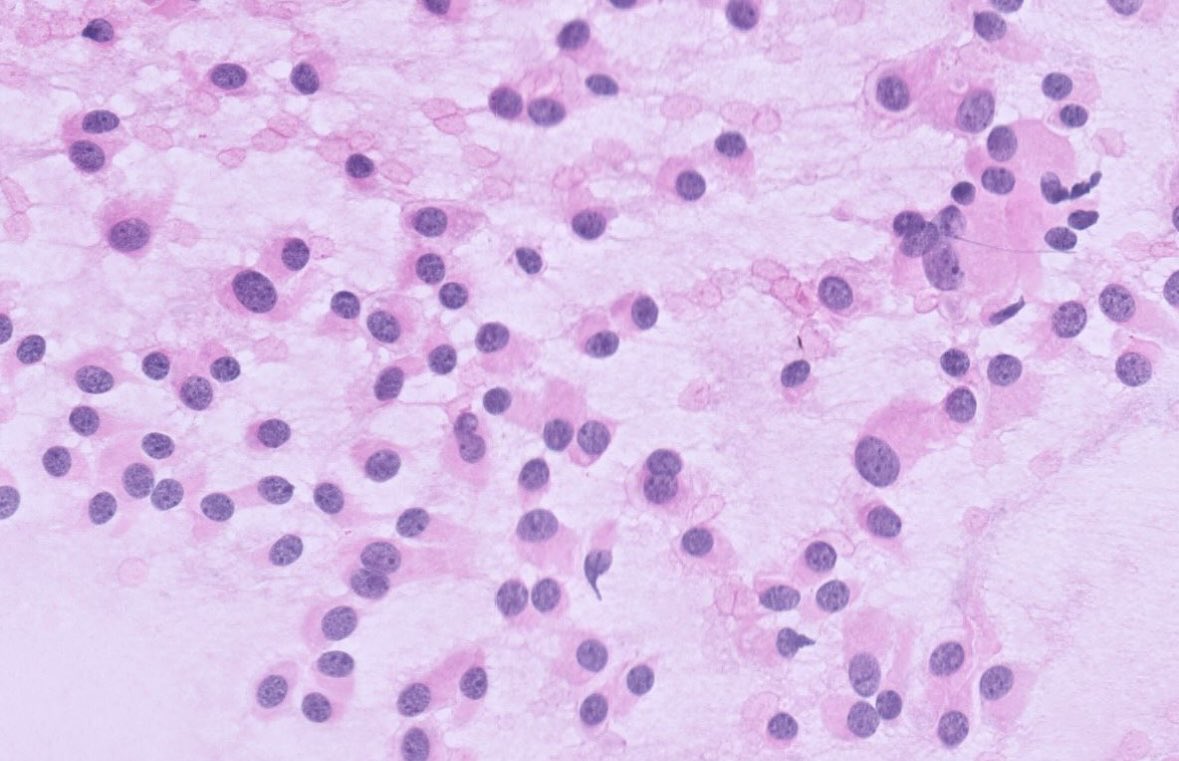 Smears from a Cauda Equina tumor.  Dx? #cytology #cytopath #cytopathology #pathx #pathtwitter #neuropath #neuropathology #cnspathology