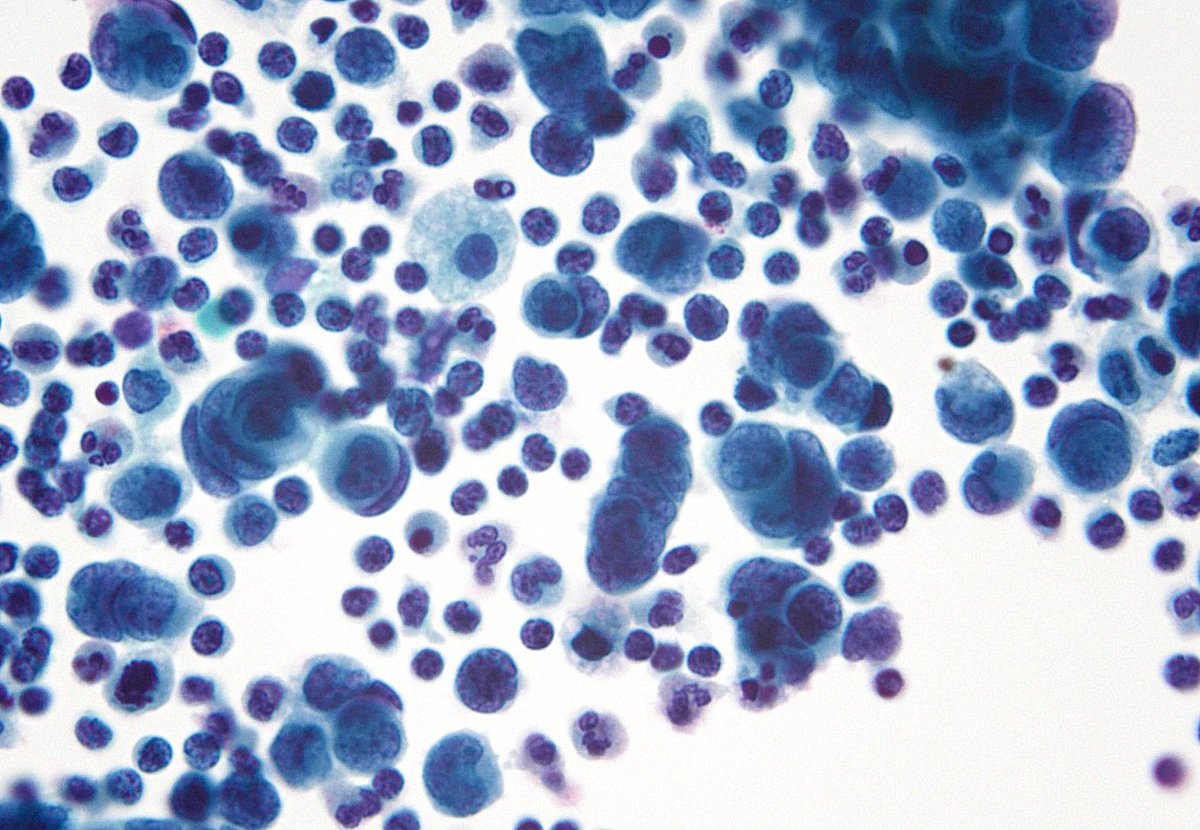Teaching "Nuclear Molding" to students and interns - Metastatic Small Cell Carcinoma in pleural fluid. (Cytospin)