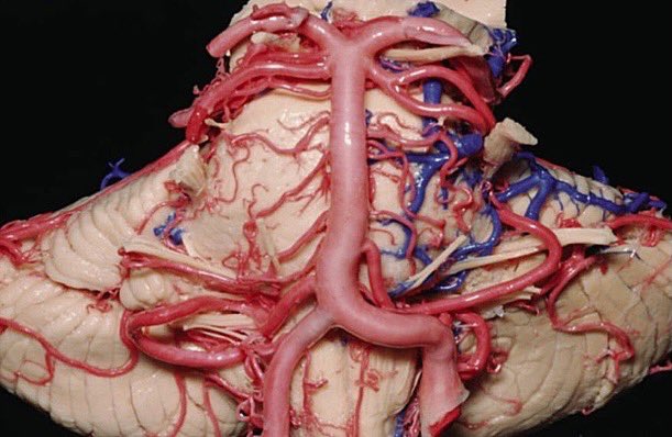 DrZNeurosurgery's tweet photo. The basilar artery is the brainstem’s central supply line. It forms from the vertebral arteries and gives rise to branches like AICA, SCA, and PCA.

It supplies the pons, midbrain, cerebellum, and inner ear. A stroke here can cause locked in syndrome, where the patient is completely paralyzed but fully conscious, able to move only the eyes. #Anatomy #Brain #Neuroscience #NeuroAnatomy #Medical #Neurosurgery