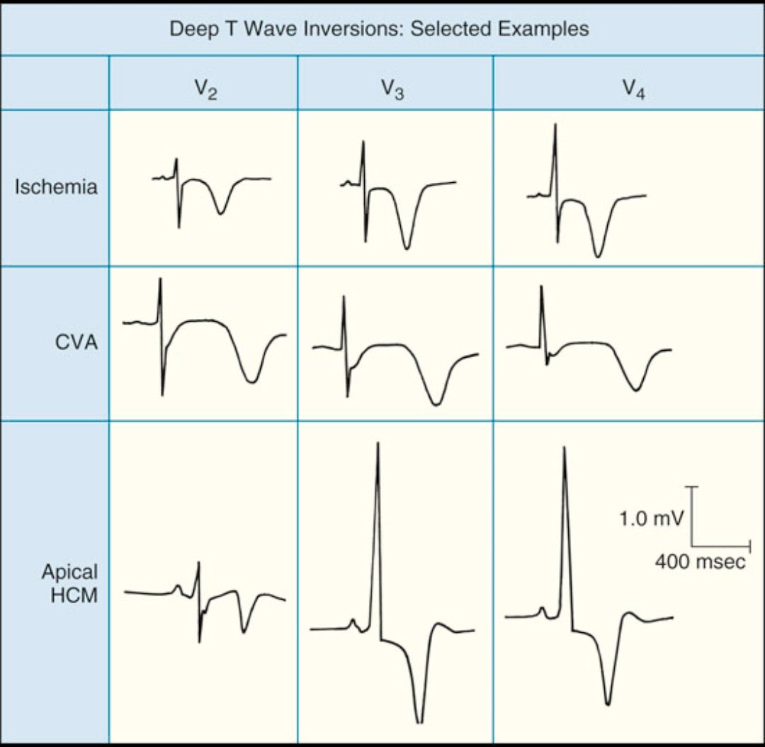 EmergenciasSiac's tweet image. Reconociendo la Inversion de la Onda T: Más Allá de la Isquemia
1️⃣ Isquemia:
2️⃣ Accidente Cerebrovascular (ACV)
3️⃣ Miocardiopatía Hipertrófica Apical
