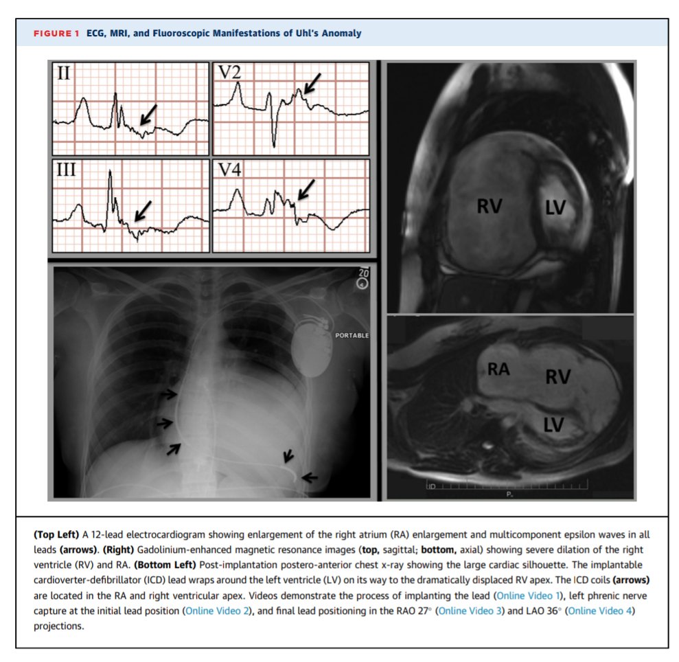 Uhl’s anomaly
dx.doi.org/10.1016/j.jace…