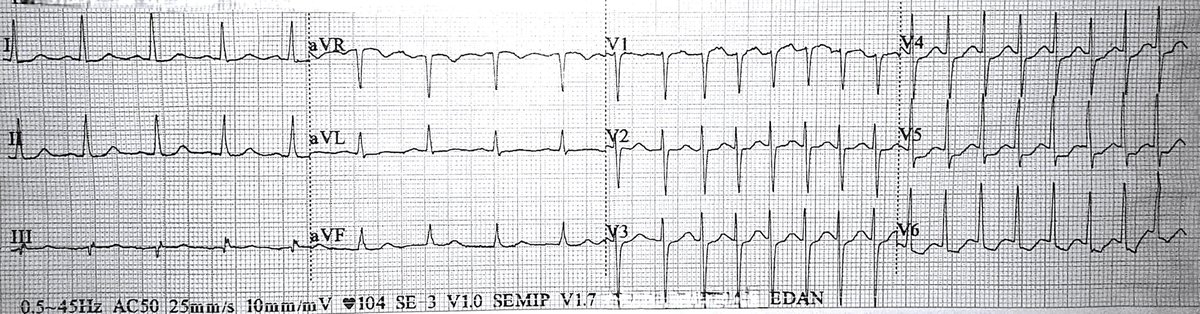 Haseeb Raza FACC, FHRS, FESC, CEPS-A, FCPS EP (@haseebephf) on Twitter photo Recurrent palpitations
What is happening in later part of ECG ?
<a href="/DrRoderickTung/">Roderick Tung</a> <a href="/Dr_JozaEP/">Jacqueline Joza</a> <a href="/narrowQRS/">JMC</a> <a href="/LuigiDiBiaseMD/">Luigi Di Biase</a>
#CardioTwitter #Epeeps #CardioEd #MedEd #MedTwitter
<a href="/escardio/">European Society of Cardiology</a>
<a href="/APHRSOfficial/">APHRS Official</a>
<a href="/ESC_Journals/">European Society of Cardiology Journals</a>
<a href="/HFA_President/">HFAPresident</a>
<a href="/EuropaceEiC/">Europace Editor-in-Chief</a>
<a href="/ehj_ed/">EHJ Editor-in-Chief</a>
<a href="/CircAHA/">Circulation</a>
<a href="/CircHF/">Circ: Heart Failure</a> Recurrent palpitations
What is happening in later part of ECG ?
<a href="/DrRoderickTung/">Roderick Tung</a> <a href="/Dr_JozaEP/">Jacqueline Joza</a> <a href="/narrowQRS/">JMC</a> <a href="/LuigiDiBiaseMD/">Luigi Di Biase</a>
#CardioTwitter #Epeeps #CardioEd #MedEd #MedTwitter
<a href="/escardio/">European Society of Cardiology</a>
<a href="/APHRSOfficial/">APHRS Official</a>
<a href="/ESC_Journals/">European Society of Cardiology Journals</a>
<a href="/HFA_President/">HFAPresident</a>
<a href="/EuropaceEiC/">Europace Editor-in-Chief</a>
<a href="/ehj_ed/">EHJ Editor-in-Chief</a>
<a href="/CircAHA/">Circulation</a>
<a href="/CircHF/">Circ: Heart Failure</a>