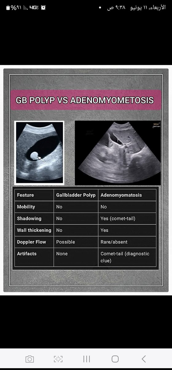 GB Polyp and Adenomyometosis
#ultrasound
#sonologist