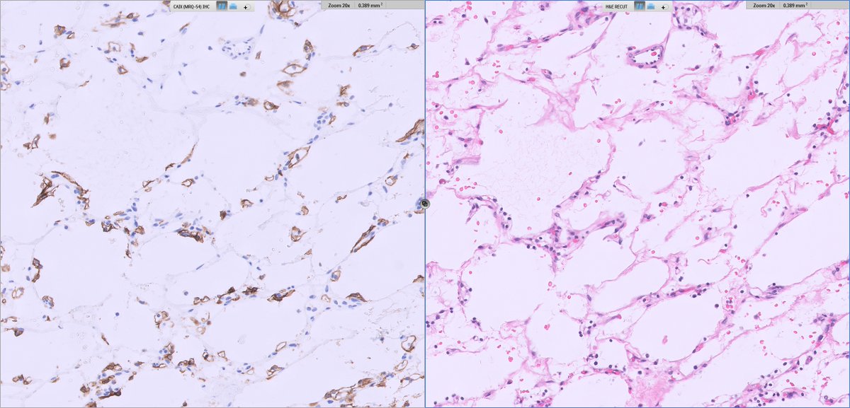 Ankur Sangoi (@slusagar) on Twitter photo all good DDx! this was perhaps indeed #TooCloseToDiagnose but <a href="/rovingatuscap/">Samson W. Fine, MD</a> was closest
this was hemangioma-like foci in a low grade clear cell RCC (lower power you can👁️more solid tumor cell aggregates)
✔️paired CA9 #IHCpath (note just how many sneaky tumor cells there are!) all good DDx! this was perhaps indeed #TooCloseToDiagnose but <a href="/rovingatuscap/">Samson W. Fine, MD</a> was closest
this was hemangioma-like foci in a low grade clear cell RCC (lower power you can👁️more solid tumor cell aggregates)
✔️paired CA9 #IHCpath (note just how many sneaky tumor cells there are!)