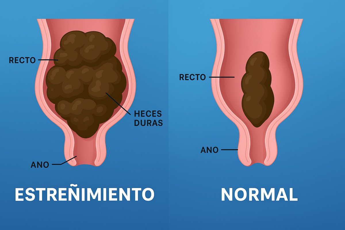 La limpieza del colon es la desintoxicación más subestimada de tu vida

Tu intestino puede almacenar hasta 5 kg de desechos.

Y cuando está saturado, contamina todo: tu hígado, tu piel, tu cerebro y tu energía.

x.com/enzosanchezia/…

Así es como puedes limpiar tu colon (de la