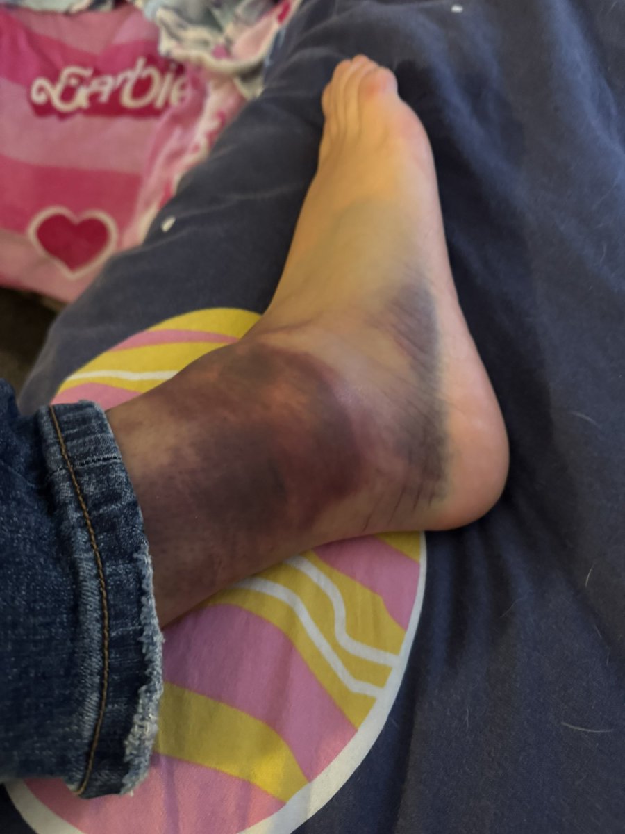 DaniRascal37's tweet image. Broken ankle 😫😔