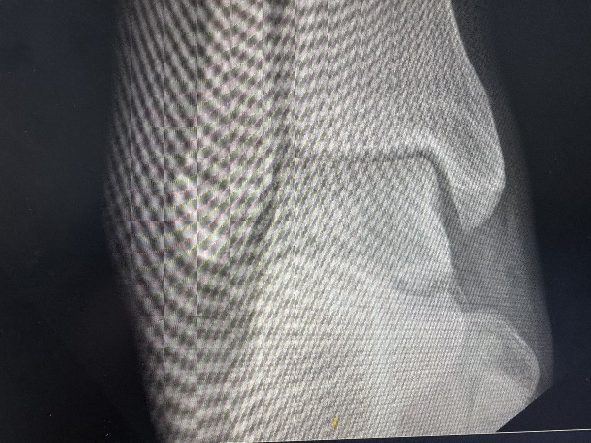DaniRascal37's tweet image. Broken ankle 😫😔
