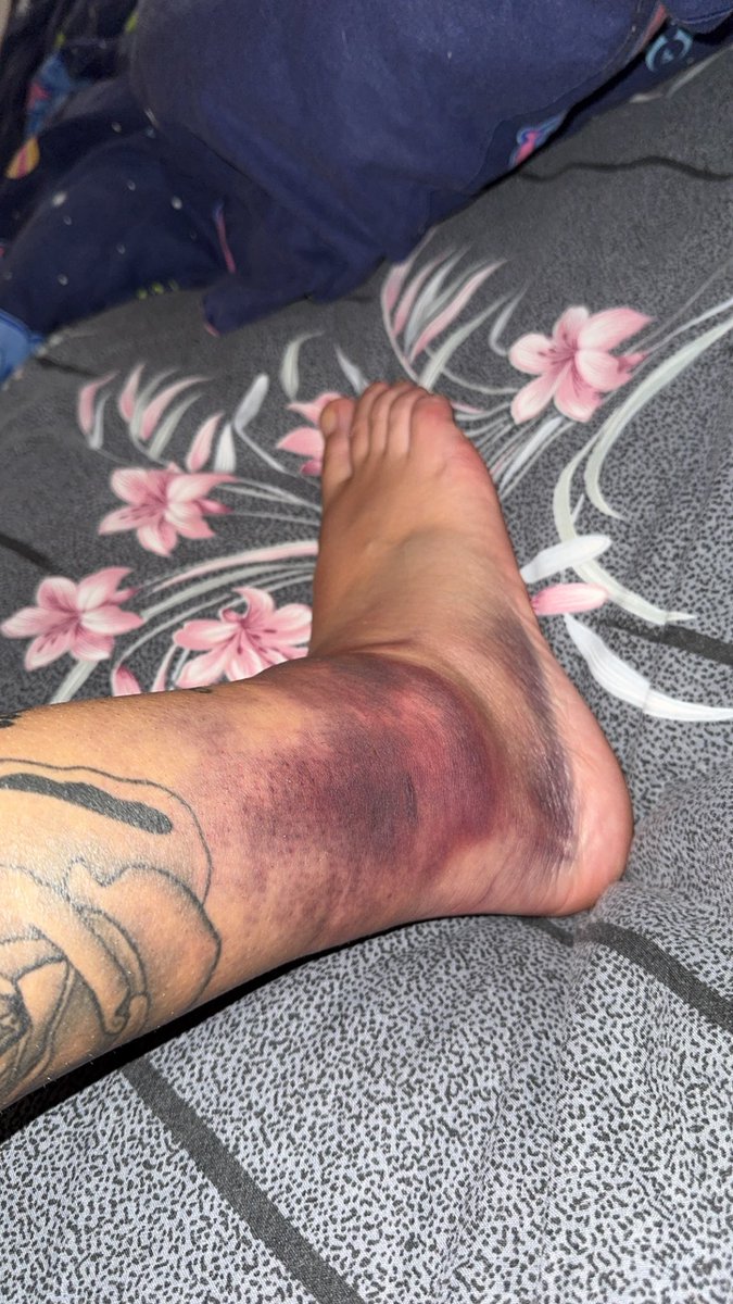 DaniRascal37's tweet image. Broken ankle 😫😔