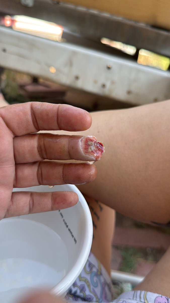 My finger today after a cleaning