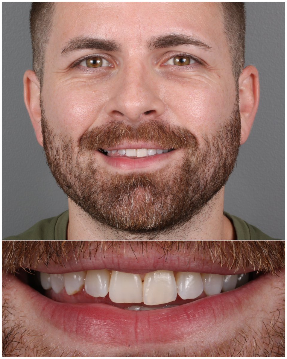 Swipe to see BEFORE ➡️
Patient’s goals: He didn’t like that his teeth were crooked and worn down. He wanted to brighten them and keep them natural looking. 
What did we do? 10 upper porcelain Harmony veneers
Time it takes: 2-3 appointments Cost: Get a FREE virtual consult