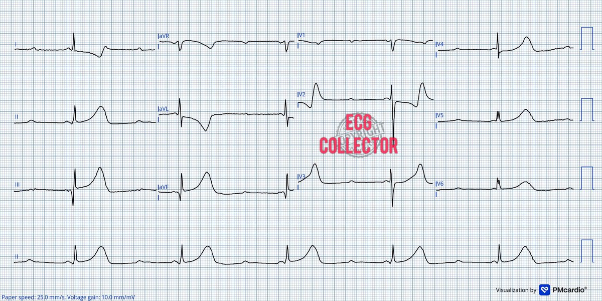 Dr Razi (@drrazi4) on Twitter photo Middle age gentleman; syncopal attack with chest pain;
What do you think🤔❓
#ECG
#Cardiology
#CardioEd
#CardioTwitter
#MedTwitter
#Medicalstudent
<a href="/PMcardioApp/">PMcardio—AI that reads ECGs</a> Middle age gentleman; syncopal attack with chest pain;
What do you think🤔❓
#ECG
#Cardiology
#CardioEd
#CardioTwitter
#MedTwitter
#Medicalstudent
<a href="/PMcardioApp/">PMcardio—AI that reads ECGs</a>