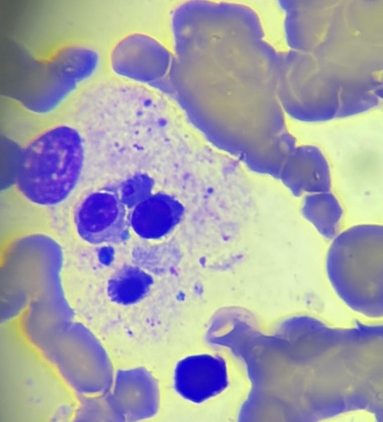 vikiamaral's tweet photo. Bone marrow of a patient with Still's disease complicated by secondary hemophagocytic lymphohistiocytosis
#SecondaryHemophagocyticLymphohistiocytosis #MacrophageActivationSyndrome #Hematology #macrophage https://t.co/wpapS7AkpG