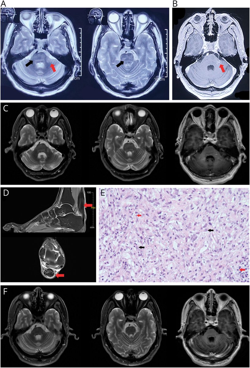 Ataxia with Achilles tendon swelling is not always CTX! Erdheim-Chester disease as CTX mimic <a href="/GreenJournal/">Neurology Journal</a> 
neurology.org/doi/10.1212/WN…