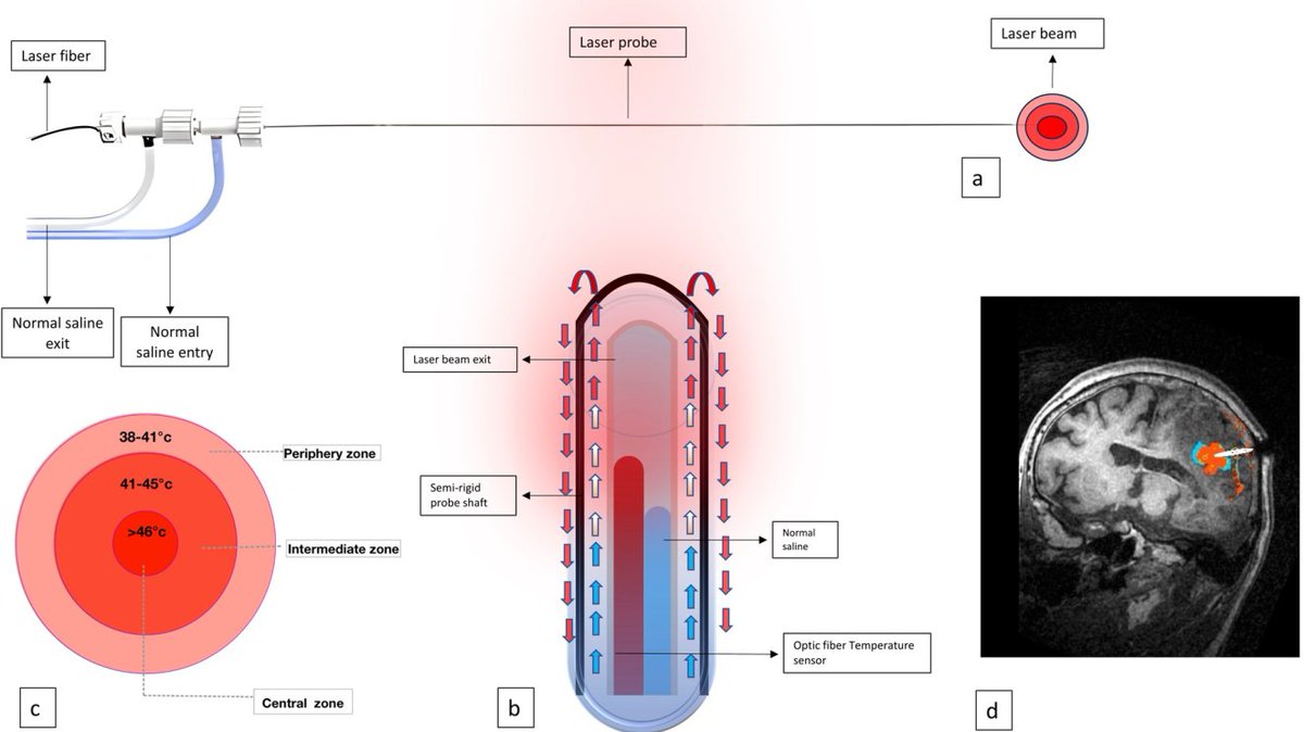 Kate Liu (@kateliu08703628) on Twitter photo 🌟 A #review introducing MR-Guided Laser Interstitial Thermal Therapy (#MRgLITT) <a href="/JINeuroscience/">Journal of Integrative Neuroscience</a> imrpress.com/journal/JIN/23…
#bloodbrainbarrier #BBB #LITT #braintumors #bloodtumorbarrier #glymphaticsystem #Neurology #Neurosurgery 🌟 A #review introducing MR-Guided Laser Interstitial Thermal Therapy (#MRgLITT) <a href="/JINeuroscience/">Journal of Integrative Neuroscience</a> imrpress.com/journal/JIN/23…
#bloodbrainbarrier #BBB #LITT #braintumors #bloodtumorbarrier #glymphaticsystem #Neurology #Neurosurgery