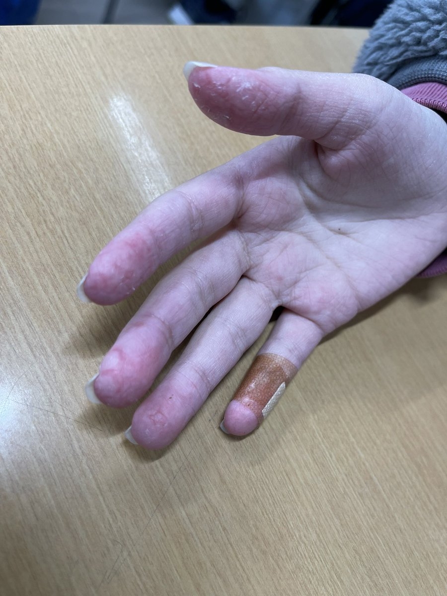 chacotakku's tweet photo. お子、毎年秋口から初夏にかけてこれよ？
何もさわれない、お風呂も1人で入れないまでになるのよ？
これの治療薬を保険適用外にするんか？
 #OTC類似薬保険適用外し反対 https://t.co/v9LQufRs89