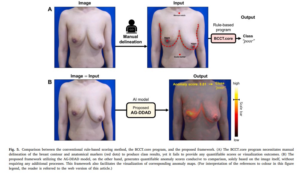 JeeSuk Chang (@changjeesuk1) on Twitter photo Assessing breast cosmesis used to be a subjective struggle.
But AI might just change that.
Our team led by AI star, Sangjoon Park & <a href="/hkbyun_/">Hwa Kyung Byun</a> , developed an automated, label-free framework that objectively evaluates cosmesis. No labels.
▶️authors.elsevier.com/c/1lFLJ3KEGaU-… Assessing breast cosmesis used to be a subjective struggle.
But AI might just change that.
Our team led by AI star, Sangjoon Park & <a href="/hkbyun_/">Hwa Kyung Byun</a> , developed an automated, label-free framework that objectively evaluates cosmesis. No labels.
▶️authors.elsevier.com/c/1lFLJ3KEGaU-…
