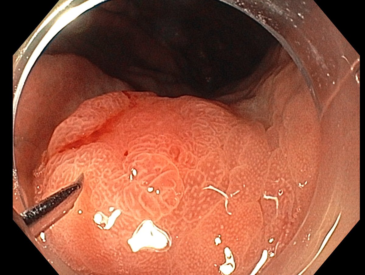 Aleksandar Gavric (@gavricale) on Twitter photo What is histology of this lesion resected in a 63 year old patient with FAP ?
Polyp is located in the proximal gastric body.
<a href="/frankbalaguer/">Francesc Balaguer</a> <a href="/kevinjmonahan/">Kevin Monahan</a> <a href="/drkeithsiau/">Keith Siau</a> What is histology of this lesion resected in a 63 year old patient with FAP ?
Polyp is located in the proximal gastric body.
<a href="/frankbalaguer/">Francesc Balaguer</a> <a href="/kevinjmonahan/">Kevin Monahan</a> <a href="/drkeithsiau/">Keith Siau</a>