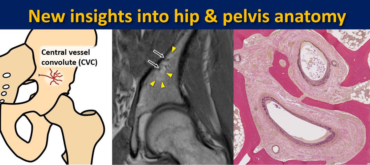SutterBalgrist's tweet image. #JustPublished: Novel anatomical observation: Prominent nutrient vessels in the ilium bone are very common, and mostly form a distinct, recognizable branching pattern, the Central Vessel Convolute (CVC).
👉Read the article for free: doi.org/10.1007/s00256…
@derbalgrist #MSKrad