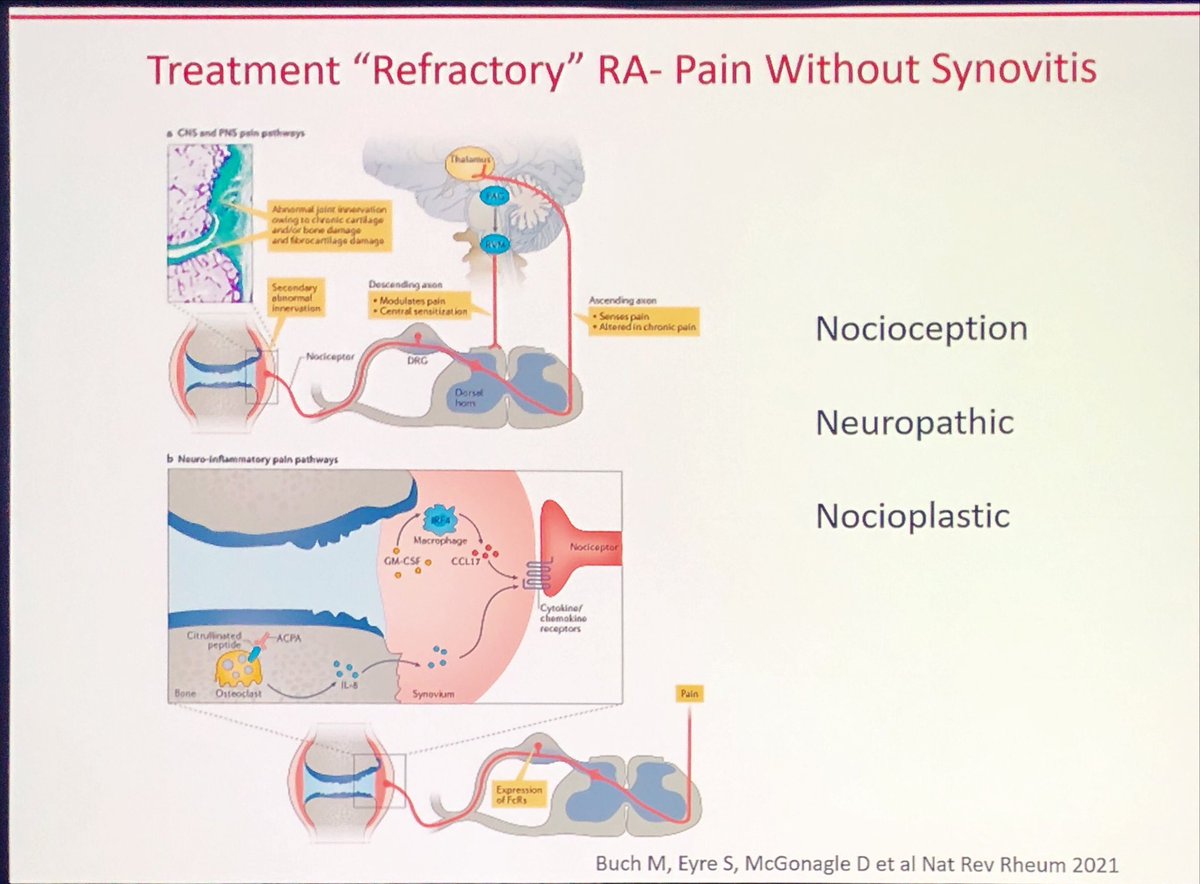 Janetbirdope's tweet photo. #polyrefractory #RA
=
failed all classes in #rheumatoid #arthritis
+inflammatory #arthritis
Longer disease duration
Late RA Rx
+power Doppler in POCUS
⬆️no refractory
BMI
Fibromyalgia - pain
⬇️SJC, less DAS , rapid X-ray progression
#EULAR2025 @RheumNow #D2T #RA https://t.co/1sPwf3Qa3m
