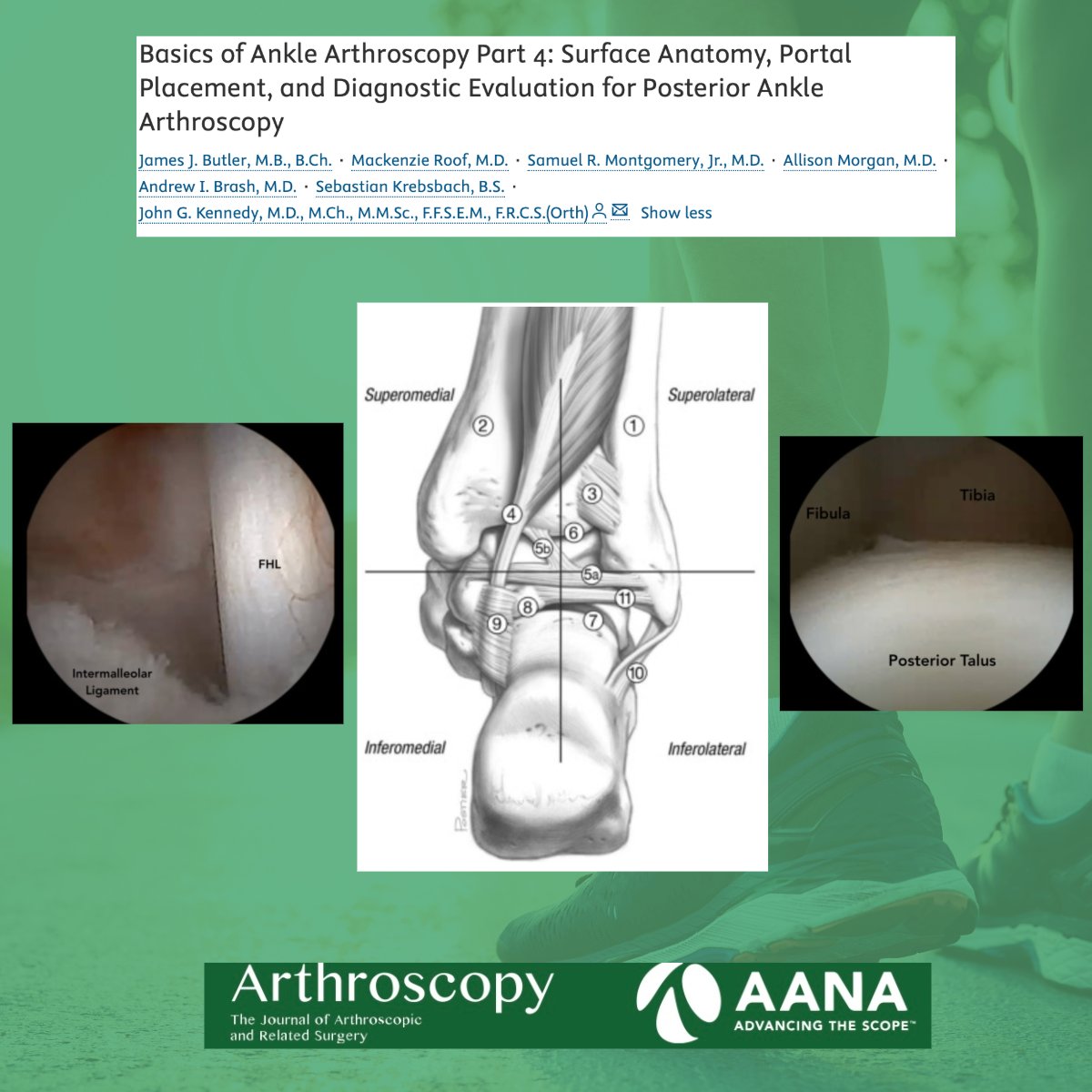 ArthroscopyJ's tweet photo. Basics of Ankle Arthroscopy Part 4: Surface Anatomy, Portal Placement, and Diagnostic Evaluation for Posterior Ankle Arthroscopy

#AnkleArthroscopy #OrthopedicSurgery #SportsMedicine

@drjohnkennedy

https://t.co/T5LgvH3pwL https://t.co/ks3BIWkSWM