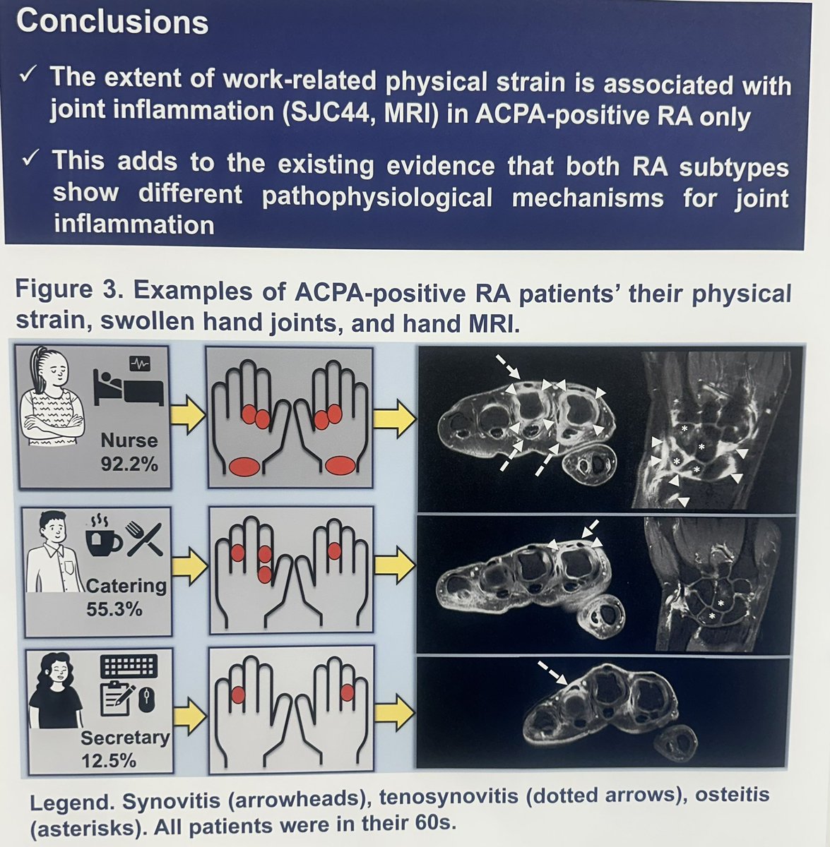 Aurelie Najm (@aurelierheumo) on Twitter photo Yes, it is relevant to ask patients about physical joint strain in RA and propose strain specific interventions
In ACPA+ RA pts for each 10% increase in strain, 7% increase in SJC44 and 5% MRI inflammation
POS0166 #EULAR2025 <a href="/RheumNow/">Dr. John Cush</a> Yes, it is relevant to ask patients about physical joint strain in RA and propose strain specific interventions
In ACPA+ RA pts for each 10% increase in strain, 7% increase in SJC44 and 5% MRI inflammation
POS0166 #EULAR2025 <a href="/RheumNow/">Dr. John Cush</a>