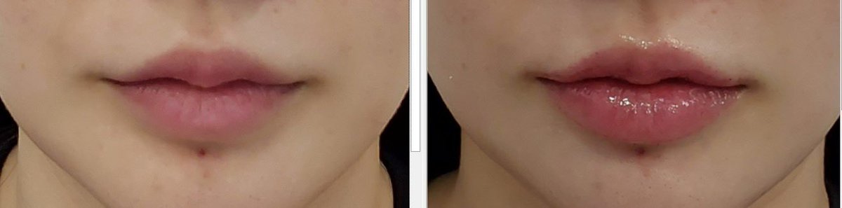 it_susang's tweet photo. 昼休み使って会社近くのNANA美容外科で初の唇ヒアルしてきた👄
理想の形とか特になくて、こんな感じの自然な感じがいいです！って症例写真見せて伝えたら、施術直後から自然なボリューム感…完璧すぎる🤝🏻✨
様子見て、残った分追加で入れてもらうか迷う🥹 https://t.co/On3T6Bq3zD