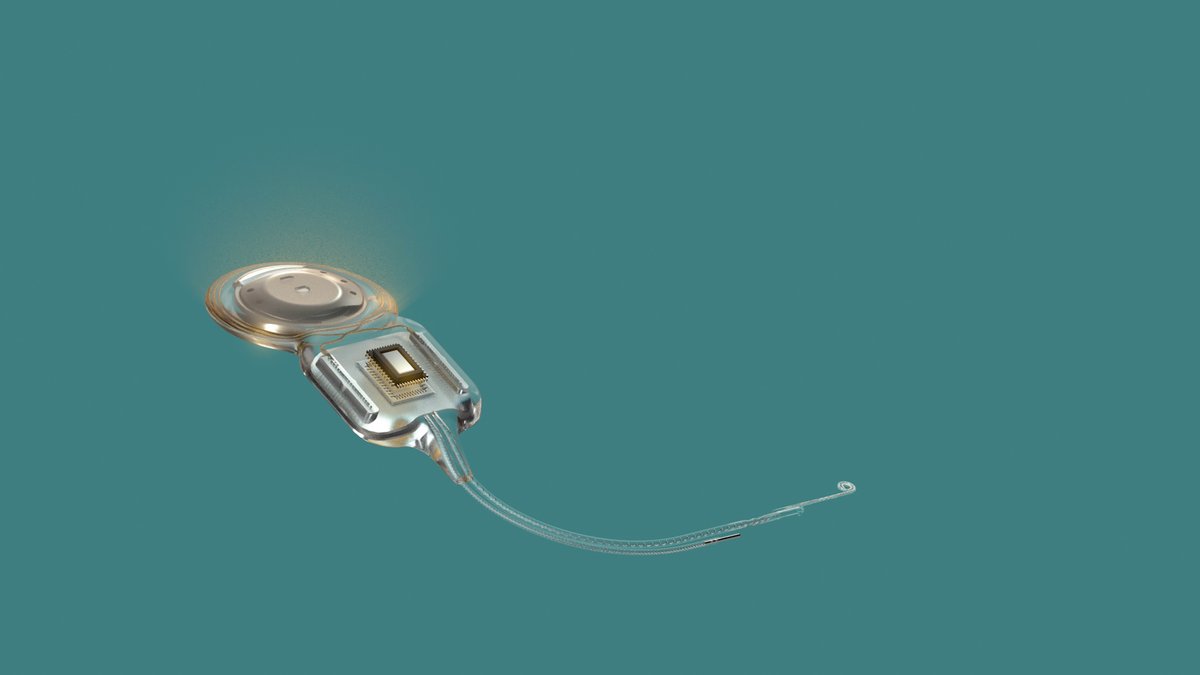Schaarschmidts's tweet image. Weltweit erstes smartes Cochlea-Implantat-System: Cochlear gibt Markteinführung von Cochlear™ Nucleus® Nexa™ bekannt – aktuelle Pressemitteilung von @CochlearDe 

presse-de.cochlear.com/pressreleases/…

#cochlear #cochleaimplantat