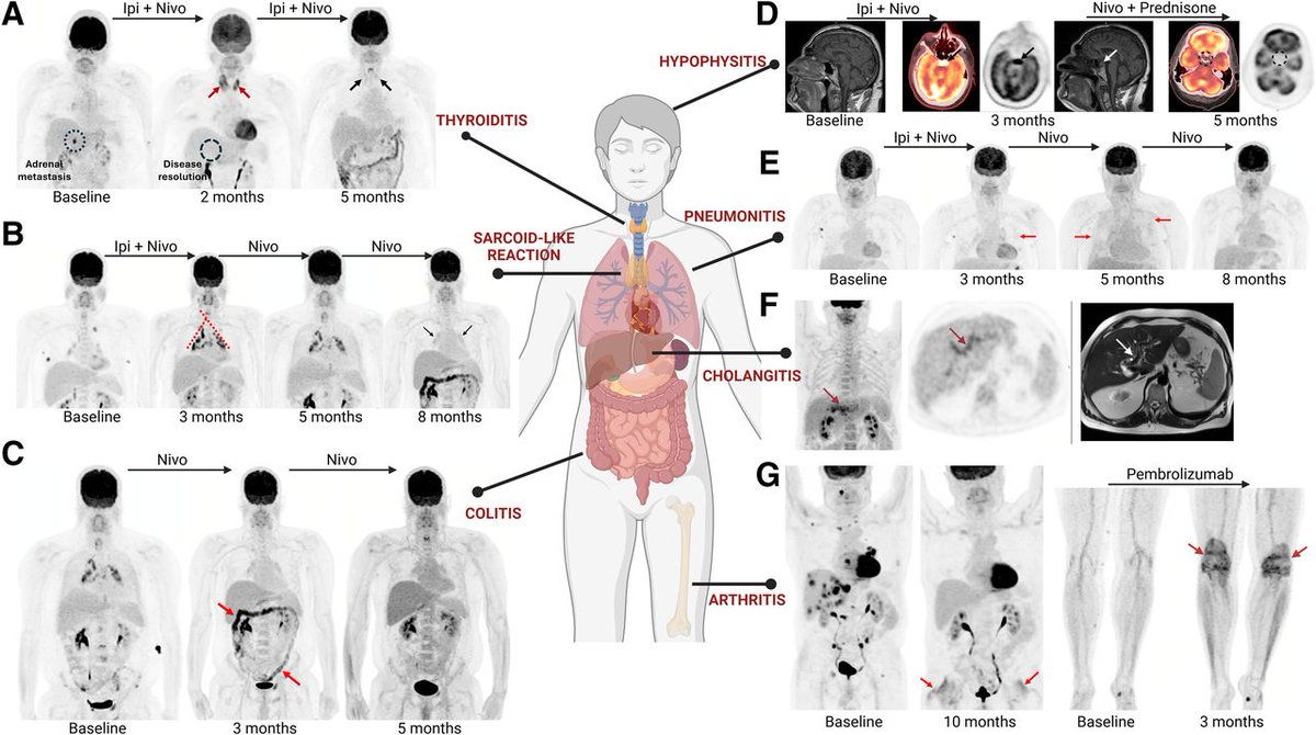JNM (@journalofnucmed) on Twitter photo Continuing Education: Approaches to imaging immune activation using PET. ow.ly/vloI50VSPSh
#PETscan #NuclearMedicine #MolecularImaging <a href="/DrAIravani/">Amir Iravani</a> <a href="/TheNUCguy/">Ashwin Singh Parihar, MBBS, MD</a> Continuing Education: Approaches to imaging immune activation using PET. ow.ly/vloI50VSPSh
#PETscan #NuclearMedicine #MolecularImaging <a href="/DrAIravani/">Amir Iravani</a> <a href="/TheNUCguy/">Ashwin Singh Parihar, MBBS, MD</a>