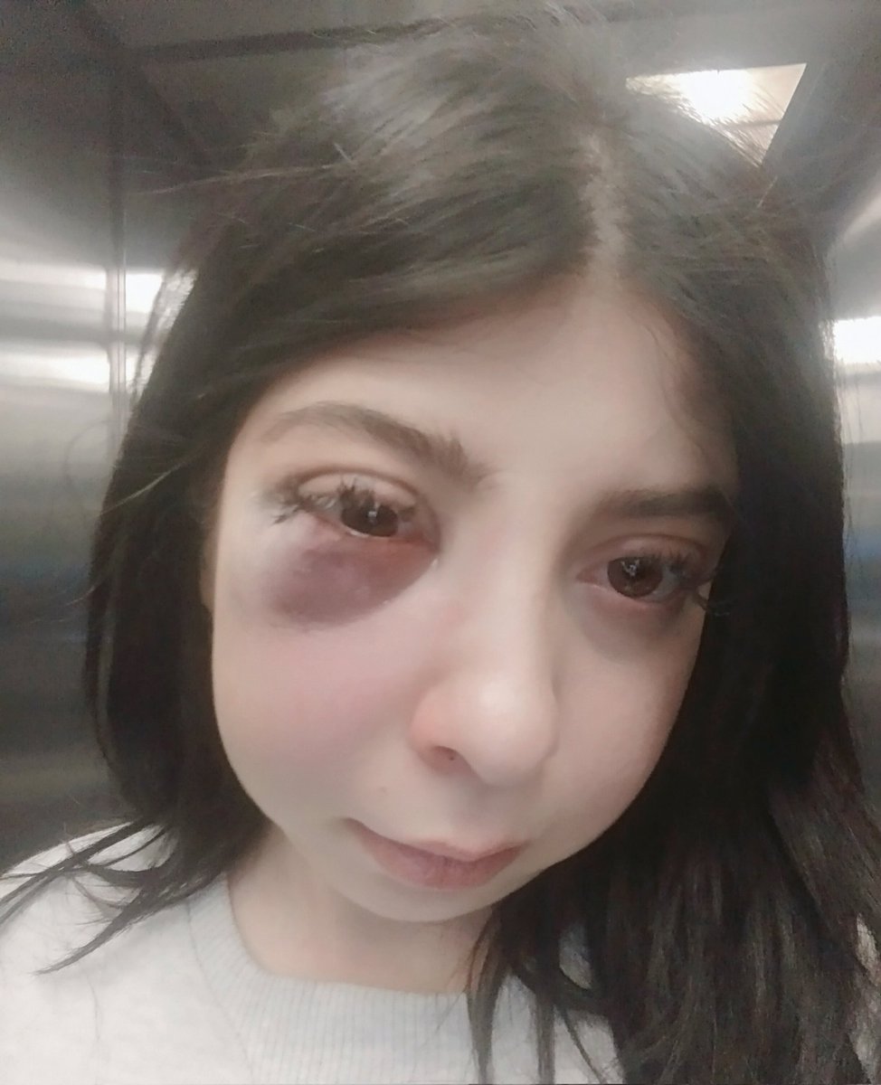 sadecedaamla's tweet photo. Tahliye kararı çıkarken bu suratım gözümün önündeydi.Kaç aydır yaşadığım sorunları ben biliyorum.
Ağlamalarım,sinir krizleri, bayılmalarım.Çalışamadığım için maddi zararları.Hiçbiriniz bunları yaşamadı.Şimdi üstüne salındı.Benim psikolojim ne olacak söyleyin+ https://t.co/PS9aKCS06p