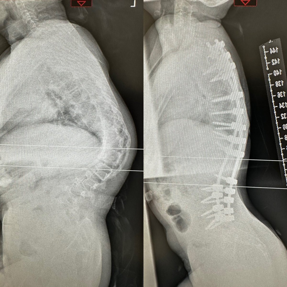 Neuromuscular scoliosis associated with Pyruvate dehydrogenase deficiency (PDD)

11 yrs old girl with this complex metabolic syndrome associated with neuromuscular scoliosis, was having difficulty sitting in her wheelchair, painful, her parents told me she couldn’t sit for more