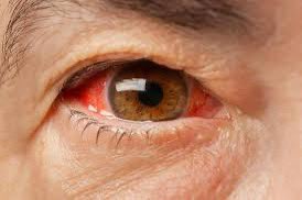 Guys, help me.

I kena mata merah macamni last month, then sekarang mata dah clear but the problem is, i secara tiba-tiba kena bengkak gusi then mata jadi kabur. 

Kena buat apa eh ? Pergi klinik semua bagi ubat mata yg sama.