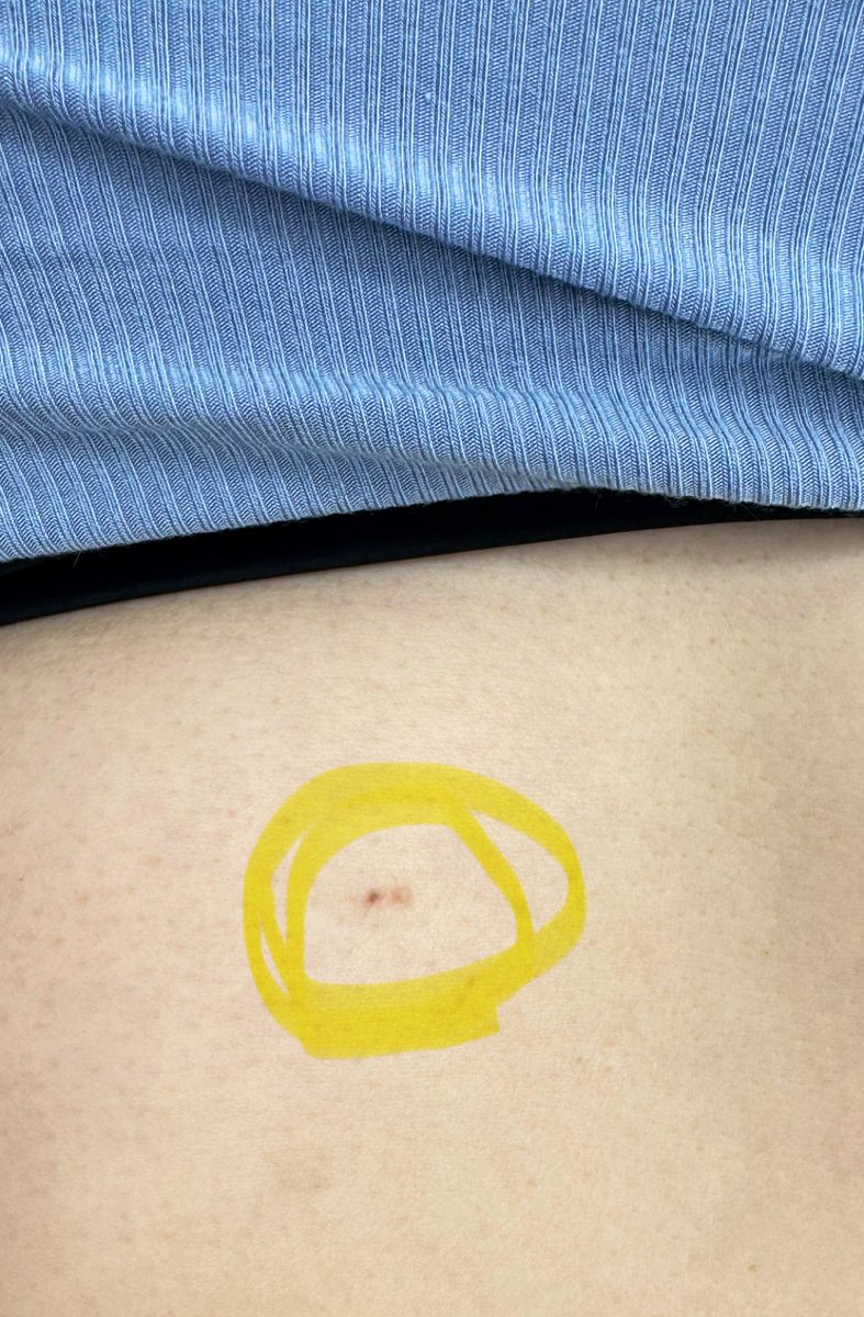 jadelu9's tweet photo. I just wanted to recommend my skin clinic to people in Taoyuan (bilingual) 我想要推薦我在青埔的皮膚科 叫 @美麗新城診所 
我有兩個一直讓我很煩惱的皮膚問題 他們很輕鬆很專業的把兩個肉肉切出來 
我本來想要拿回家當鑰匙圈 （或是偷偷餵我老公） 🤣但是他們需要寄做檢驗 所以就沒辦法拿回來了 https://t.co/GrseqWkwGX