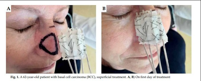 In order to demonstrate capabilities of brachytherapy in skin cancer treatment, we reviewed clinical outcomes of patients with non-melanoma skin cancer (NMSC) treated with high-dose-rate brachytherapy (HDR-BT) at a single-institution. 
termedia.pl/High-dose-rate…