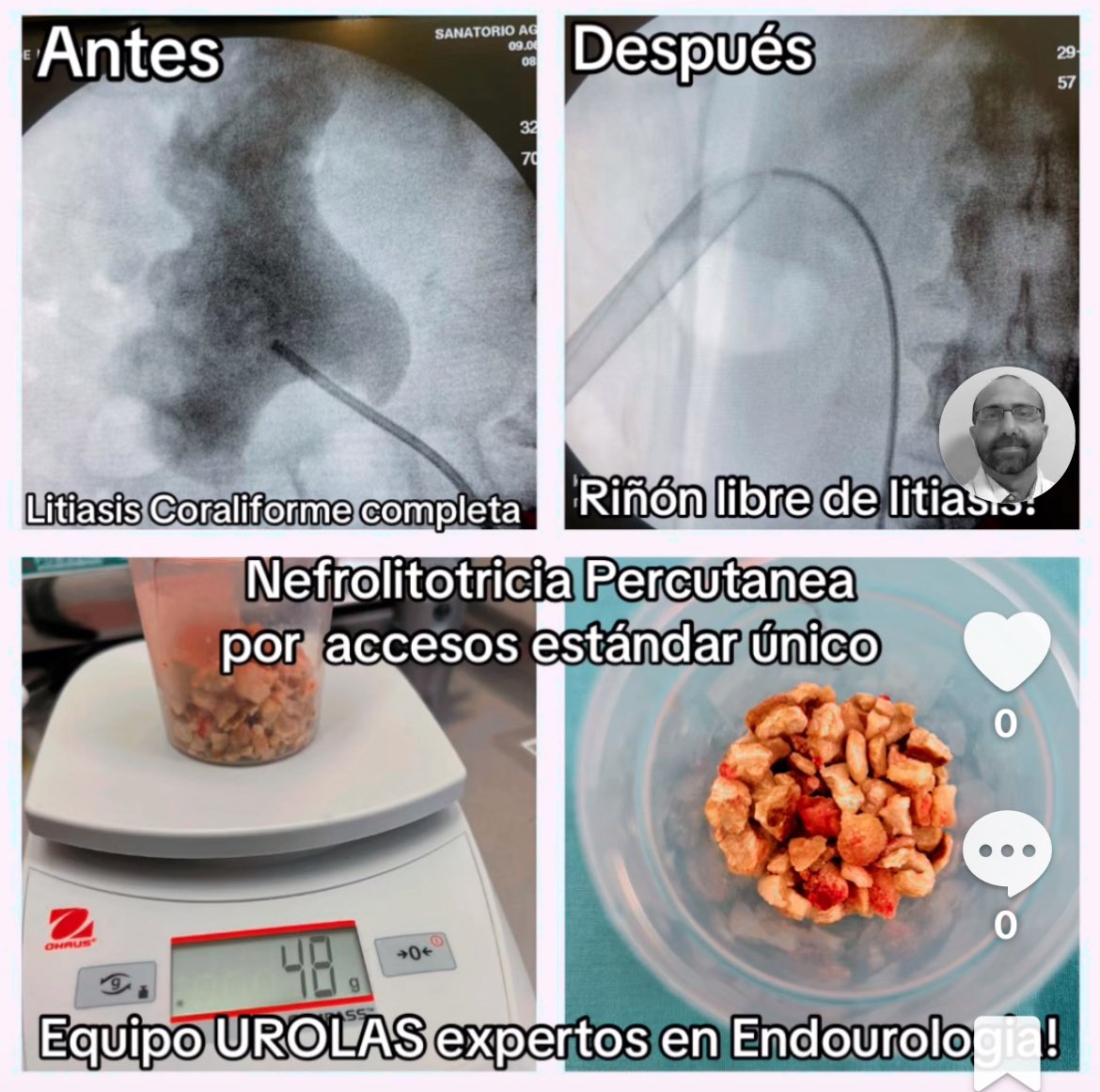 In this sequence of images we can see a case of complete staghorn lithiasis successfully resolved by the Urolas team with standard percutaneous surgery through a single access resulting in a kidney completely free of stones. #EndourologiaArgentina #staghornrenallithiasis #PCNL