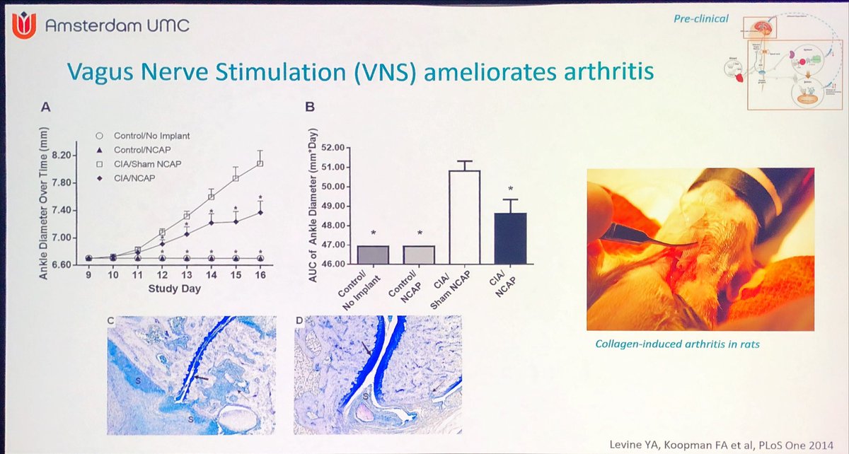Janetbirdope's tweet photo. #vagal & #splenic #nerves most studied
In #immune #system interaction
#PNS can detect #inflammation
use in #D2T #RA w active disease ?
Key factors in #neurostimulation - many
#EULAR2025 @RheumNow @eular_org
#D2T in #RA session https://t.co/tCgpGtI5z2