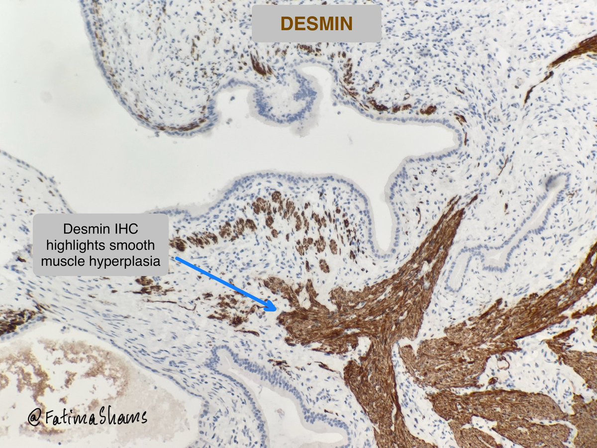 📣📣📣 Diagnosis: Gallbladder - Adenomyomatous hyperplasia in a background of chronic calculous cholecystitis
 
•Also called adenomyoma (localized), adenomyomatosis (diffuse)
•Benign reactive nonneoplastic lesion of the gallbladder
•Associated with chronic inflammation /