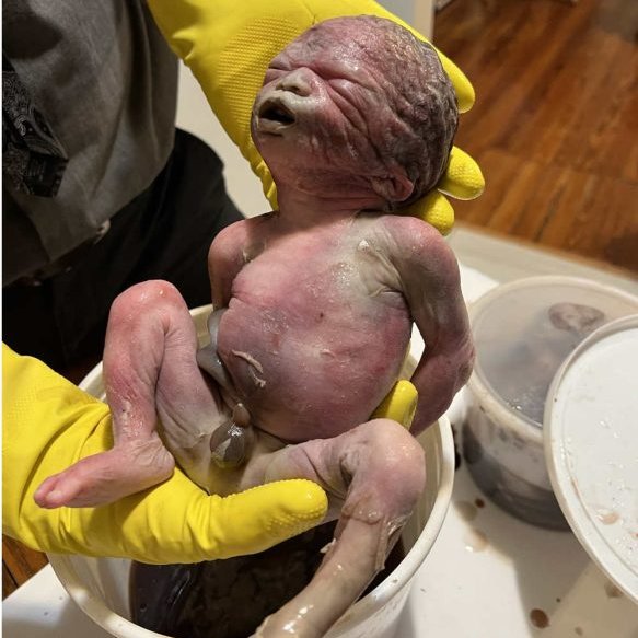 LiveAction's tweet photo. This is what a 3rd trimester abortion looks like.

Baby Christopher X was estimated 28-32 weeks at the time of his abortion.

His body was found in a medical waste bin outside of a D.C. abortion business.

You cannot look at this and still claim abortion doesn't kill a child. https://t.co/pdlBQZvV6T