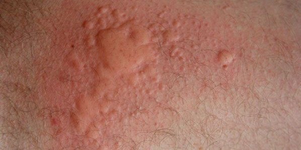 kabigwa_78's tweet image. “ALLERGY INAWEZA KUKUUA DAKIKA 5 TU… LAKINI WENGI WANAICHUKULIA KAMA MZAA MZAA TU!”

Uzi mrefu wa kusisimua, kuelimisha, na kuogofya kuhusu ALLERGY — adui hatari anayeishi kimya kimya ndani ya miili yetu 

🧵👇🏾