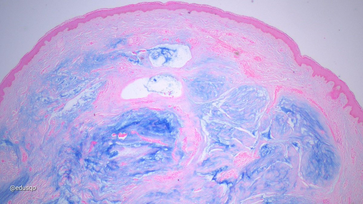 Superficial angiomyxoma:
▫️Myxoid lesion sometimes associated w Carney complex
▫️Painless nodule/polyp
▫️Hypocellular dermal/subcutaneous lesion
▫️Spindle/stellate cells + thin walled vessels + myxoid stroma
▫️Alcian blue is 😍
#DermPath