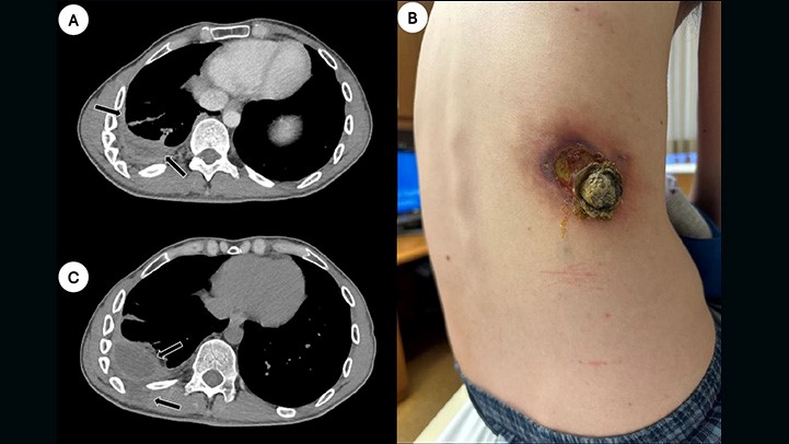 Medical image: Computed tomography of the chest revealed a loculated right-sided pleural effusion with extension into the surrounding soft tissue structures.
mayocl.in/446YJxo