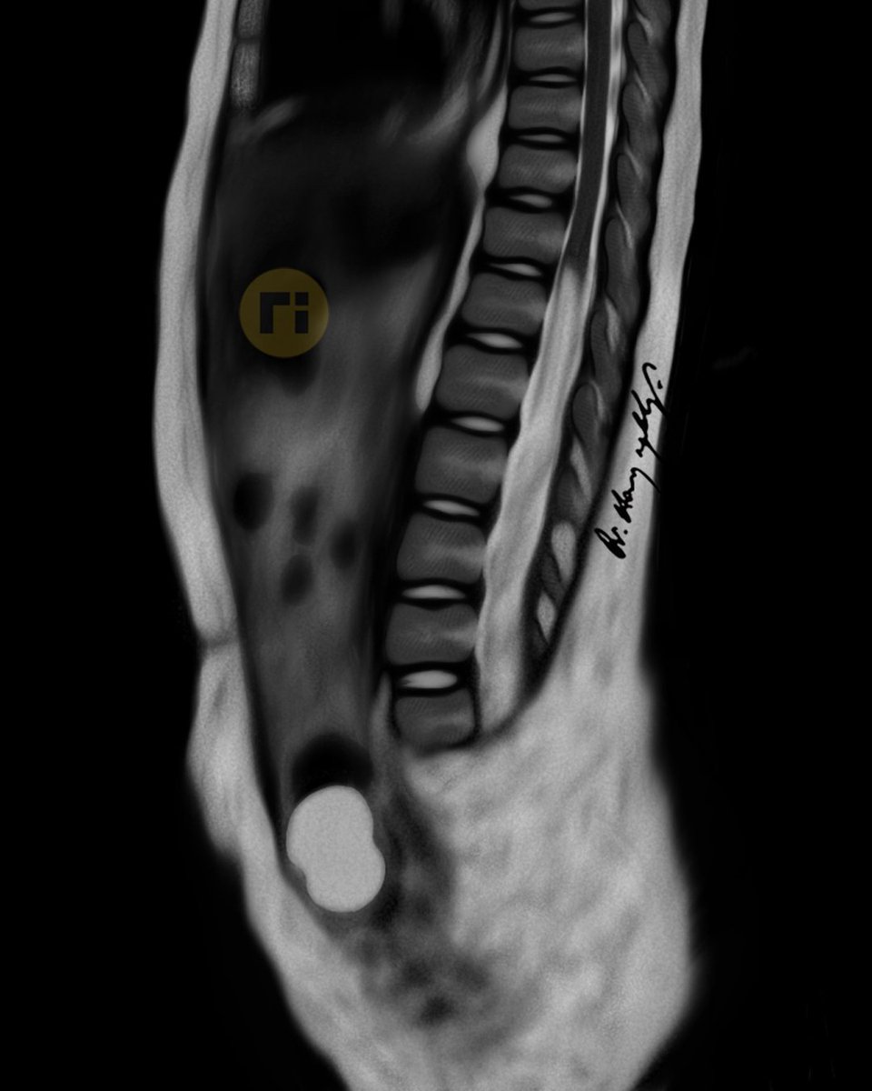 drharunyildiz's tweet image. Caudal Regression Syndrome (Type I)
doi.org/10.1016/j.wneu…
#radiologicalillustration ✍️
pixel by pixel handmade!