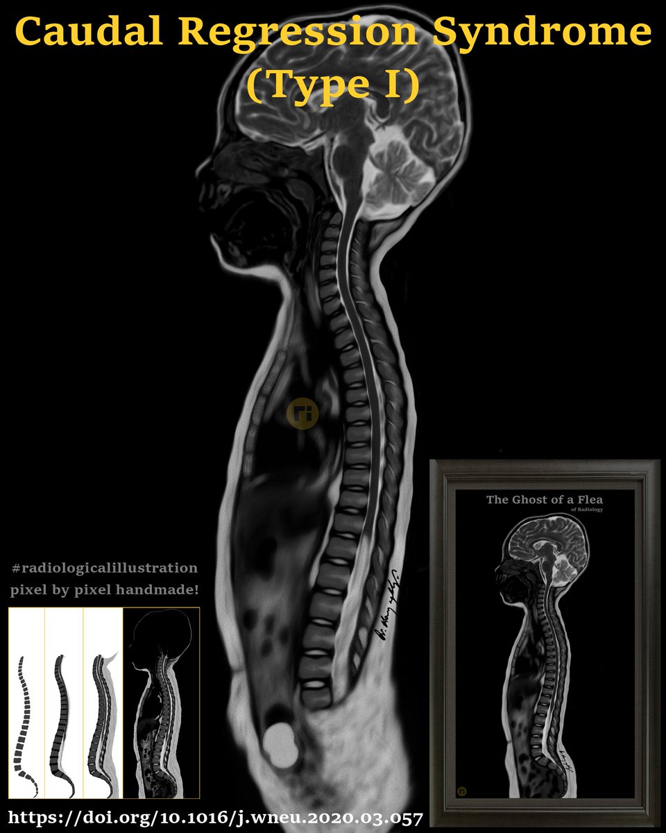drharunyildiz's tweet image. Caudal Regression Syndrome (Type I)
doi.org/10.1016/j.wneu…
#radiologicalillustration ✍️
pixel by pixel handmade!