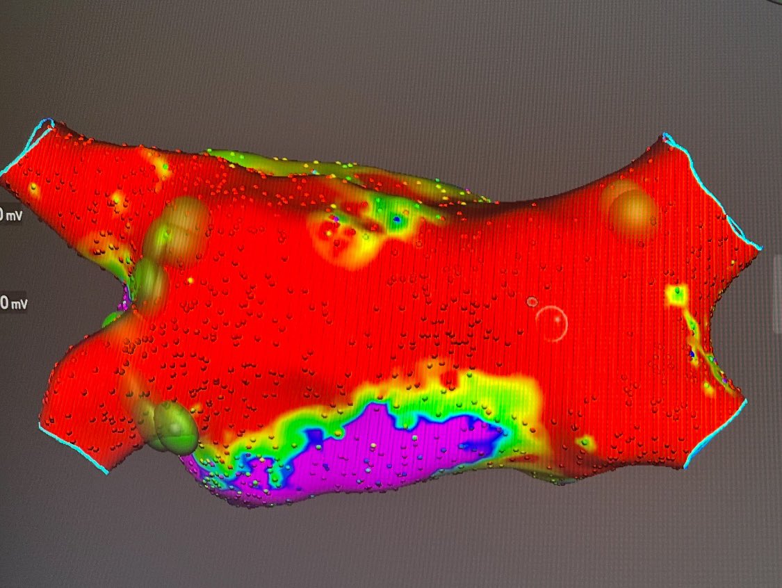 Extensive left atrial disease in a patient with ARVC. Is atrial myocardial substrate driven by genetically determined desmosomal dysfunction? 
<a href="/SteliosDragasis/">Stelios</a> <a href="/Kariki_O/">Ourania Kariki</a> <a href="/athsaplaouras/">Athanasios Saplaouras</a> <a href="/ipetemil/">Panagiotis Mililis</a>
<a href="/PetrosSkalidis/">Petros Skalidis</a> 
<a href="/koskinastavrina/">Stavrina Koskina</a> <a href="/MEfraimidis/">Michail Efremidis</a> 
 #OCSC #Epeeps