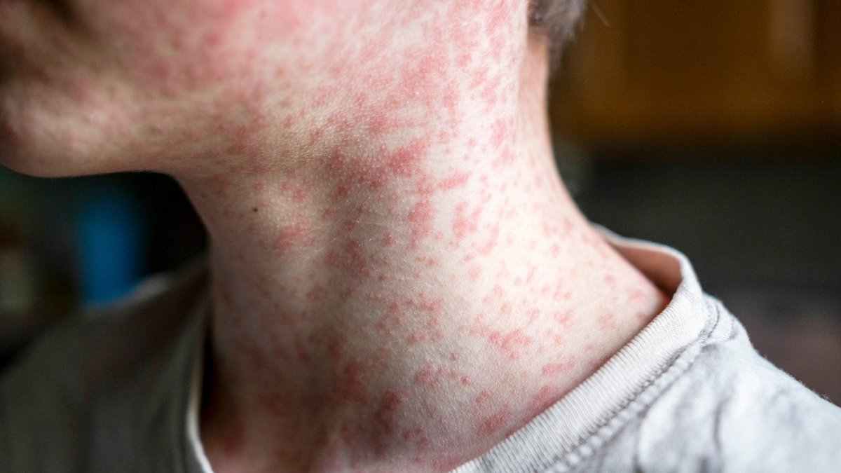 Measles is a highly contagious disease, and it’s now in Iowa. Do you know how to protect yourself and your family? Make sure vaccinations are up to date, be aware of symptoms, and call your provider if you have concerns. uihc.pulse.ly/zc3mwacrux