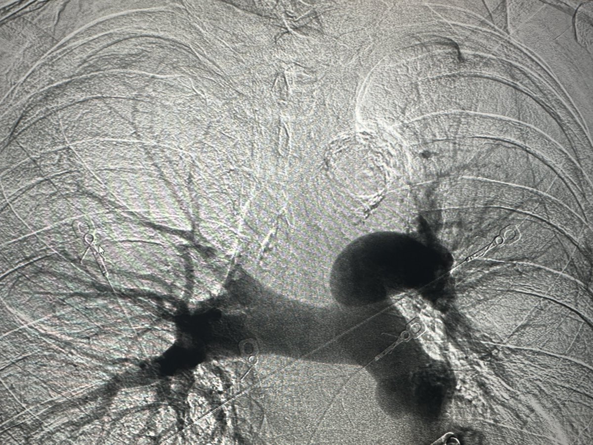 Jalil Kalantari, MD, MS (@jalilka87) on Twitter photo Not a huge fan of these but definitely among the largest #clots #thrombectomy <a href="/InariMedical/">Inari Medical</a> #PE Max high flow ->2L NC Not a huge fan of these but definitely among the largest #clots #thrombectomy <a href="/InariMedical/">Inari Medical</a> #PE Max high flow ->2L NC