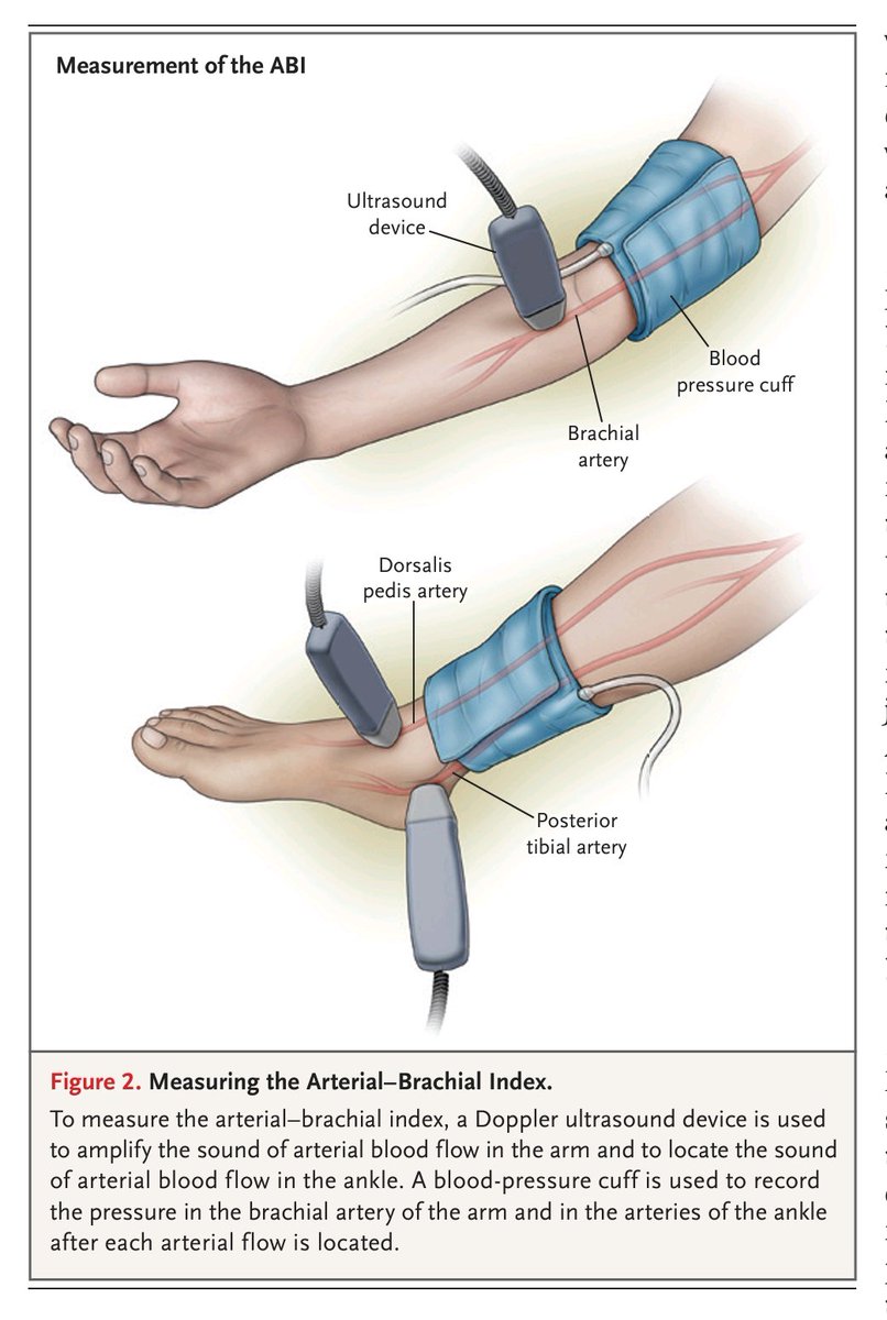 Evaluation and Management of Lower-Extremity Ulcers- NEJM (2017):
🧵Úlceras de extremidades inferiores: diagnóstico y manejo clínico
📌Una revisión sólida sobre un problema frecuente, costoso y de difícil manejo.
🔽Sigue el hilo
🧠📚👣
🩺🧵
1️⃣ Panorama general
📊 Prevalencia: