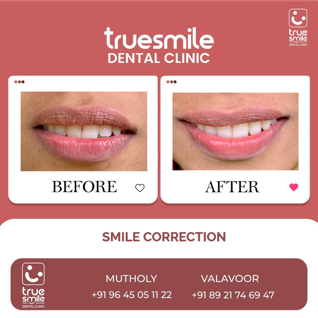 True Smile Dental Clinic (@clinictrue) on Twitter photo โจ ๐๐๐๐๐ฒ ๐ญ๐จ ๐ญ๐ซ๐๐ง๐ฌ๐๐จ๐ซ๐ฆ ๐ฒ๐จ๐ฎ๐ซ ๐ฌ๐ฆ๐ข๐ฅ๐? โจ
At ๐๐ซ๐ฎ๐ ๐๐ฆ๐ข๐ฅ๐ ๐๐๐ง๐ญ๐๐ฅ ๐๐ฅ๐ข๐ง๐ข๐, we specialize in ๐๐ฆ๐ข๐ฅ๐ ๐๐จ๐ซ๐ซ๐๐๐ญ๐ข๐จ๐ง, helping you achieve the confident, radiant smile you've always wanted. โจ ๐๐๐๐๐ฒ ๐ญ๐จ ๐ญ๐ซ๐๐ง๐ฌ๐๐จ๐ซ๐ฆ ๐ฒ๐จ๐ฎ๐ซ ๐ฌ๐ฆ๐ข๐ฅ๐? โจ
At ๐๐ซ๐ฎ๐ ๐๐ฆ๐ข๐ฅ๐ ๐๐๐ง๐ญ๐๐ฅ ๐๐ฅ๐ข๐ง๐ข๐, we specialize in ๐๐ฆ๐ข๐ฅ๐ ๐๐จ๐ซ๐ซ๐๐๐ญ๐ข๐จ๐ง, helping you achieve the confident, radiant smile you've always wanted.