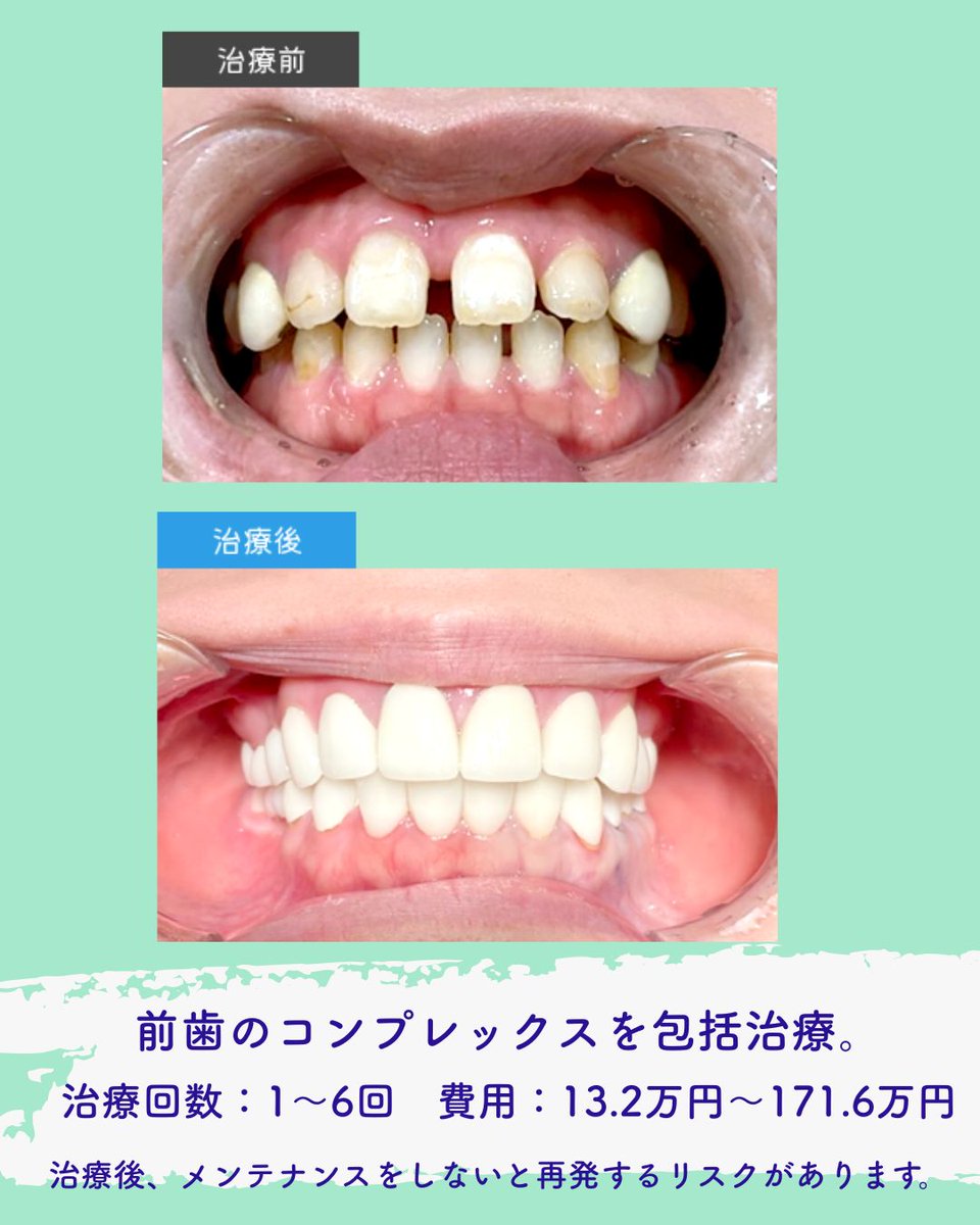 yorisoudc's tweet photo. おはようございます。
本日は休診日です。

今回は症例のご紹介です。

コンプレックスを持っている前歯を包括治療で理��の前歯に。
審美治療もお任せください。

#北千住　#自費診療　#歯医者 https://t.co/R8tDgsR5H7